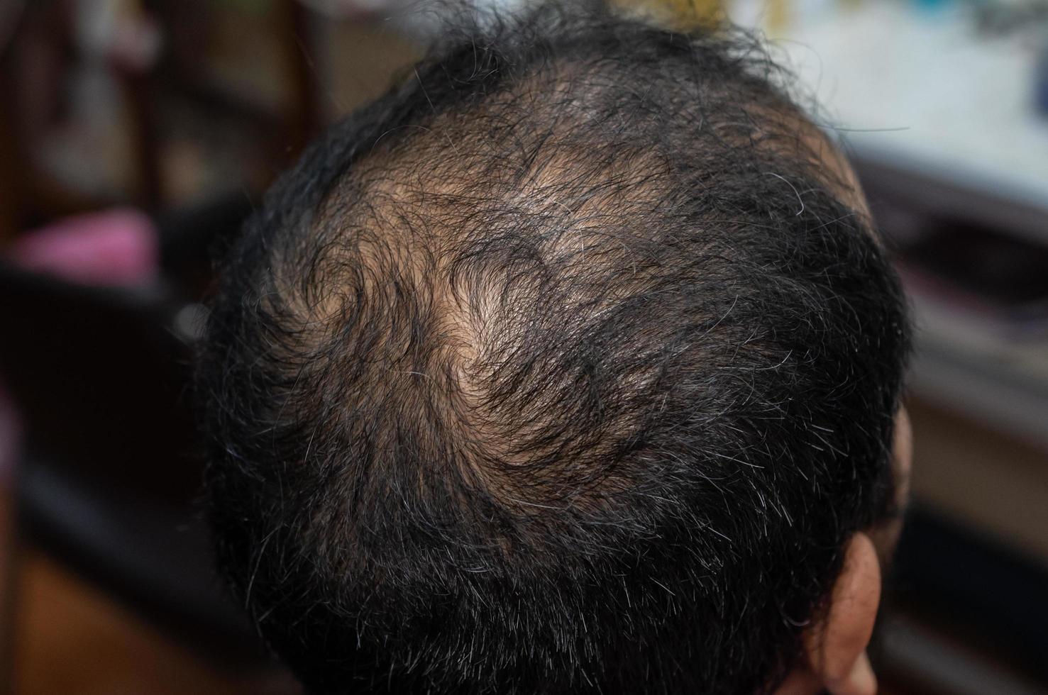 Male Pattern Baldness Male Pattern Baldness