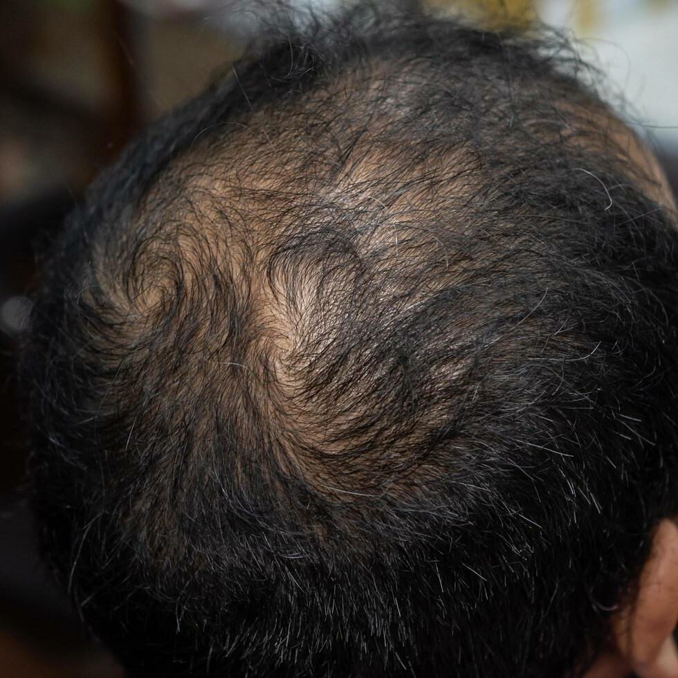 Male Pattern Baldness